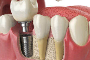 The Silent Revolution: How Dental Implants Preserve Jaw Health